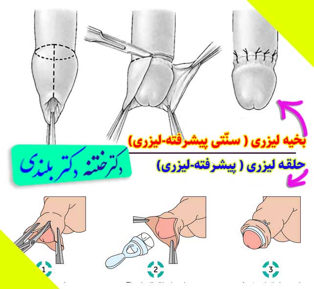 کلینیک ختنه پیشرفته تهران ختنه کرج بهترین دکتر ختنه دکتر بلندی تکنیک ختنه روش های ختنه 1
